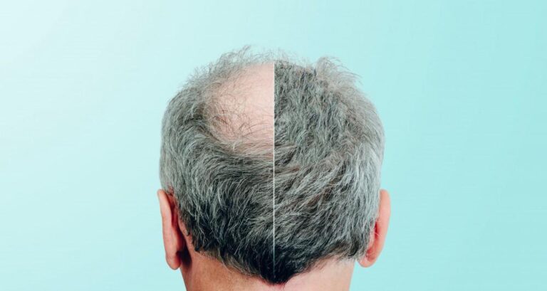 Exploring the Benefits of Laser Therapy for Hair Loss